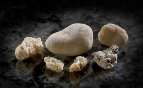  磷酸盐型结石「磷酸盐结石显影吗」