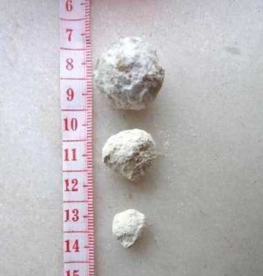 尿结石白色是磷酸盐结石吗